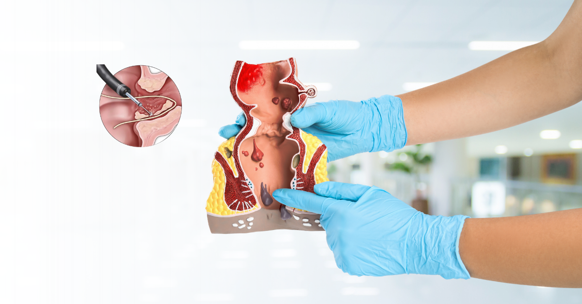 Surgical Technique Used in Fistula Surgery